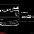 Tumeur glomique du doigt: IRM